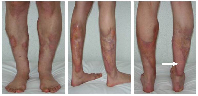 Free autologous tissue transplantation after complicated contouring of the lower limbs 1