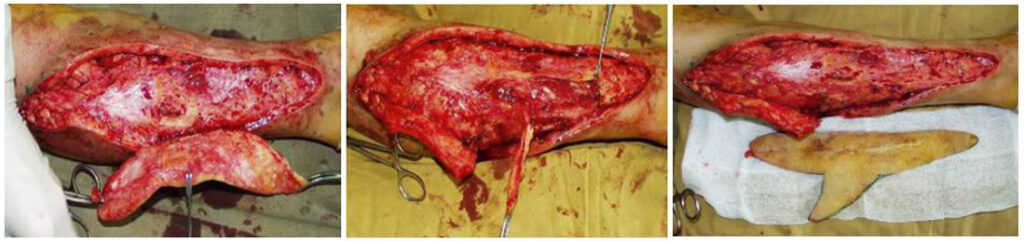 Free autologous tissue transplantation after complicated contouring of the lower limbs 2 1024x242