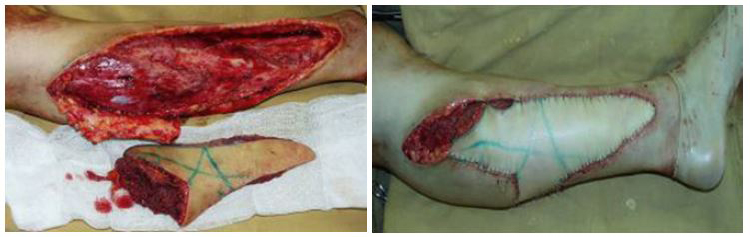 Free autologous tissue transplantation after complicated contouring of the lower limbs 4