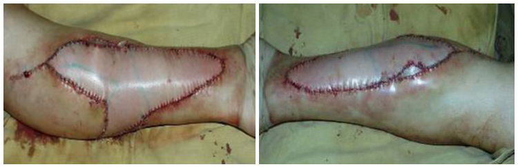 Free autologous tissue transplantation after complicated contouring of the lower limbs 5