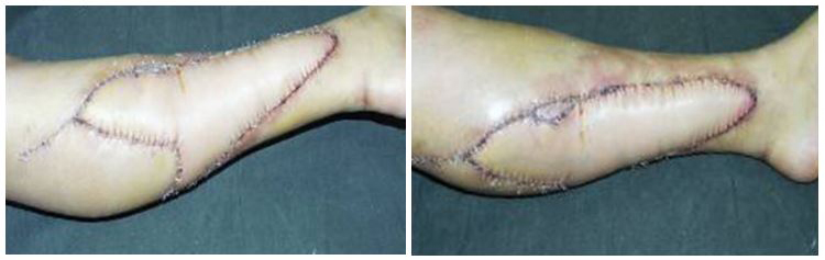 Free autologous tissue transplantation after complicated contouring of the lower limbs 6