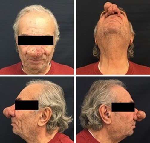 Non standard clinical situation in rhinosurgery 1