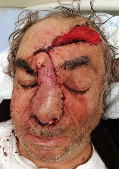 Non standard clinical situation in rhinosurgery 4