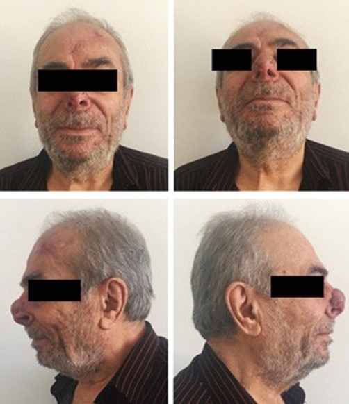 Non standard clinical situation in rhinosurgery 5