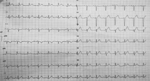 Takotsubo cardiomyopathy in an elderly woman 1