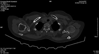 AJHMS N2 Mukuchyan Pagets disease 1